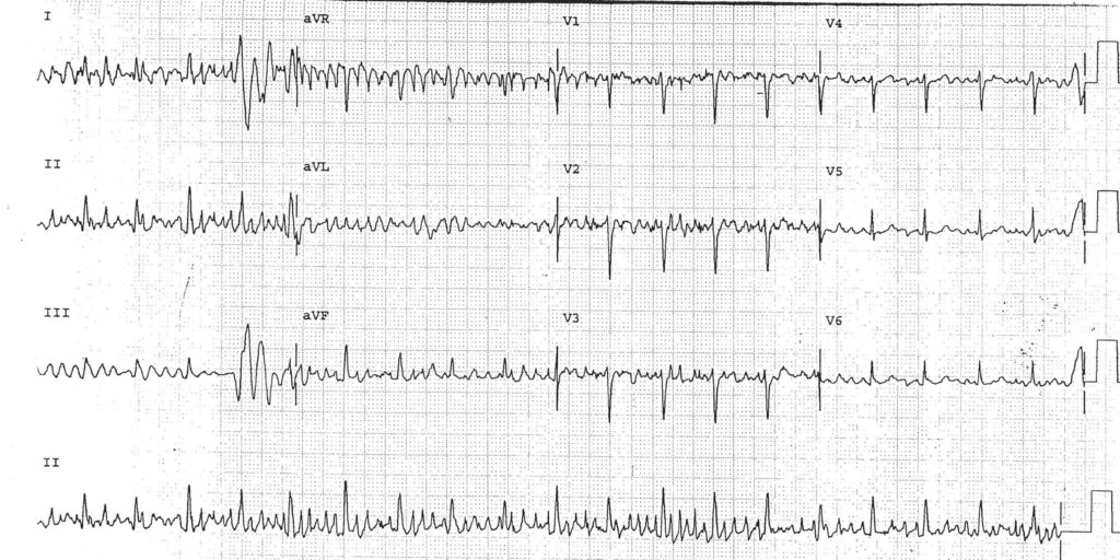 Baseline Artifact, Parkinson's, tremors