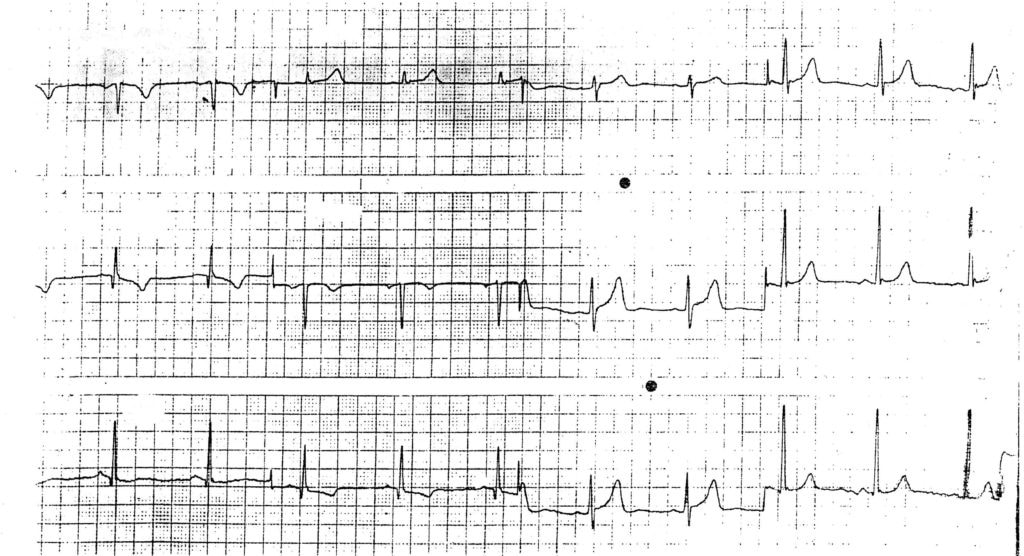 Error arm lead reversal