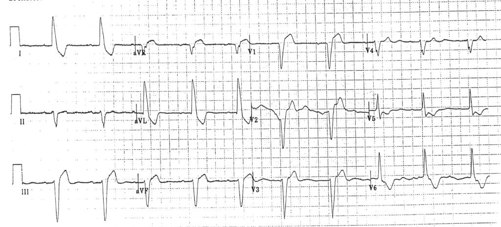 Left bundle branch block mimicking myocardial infarction