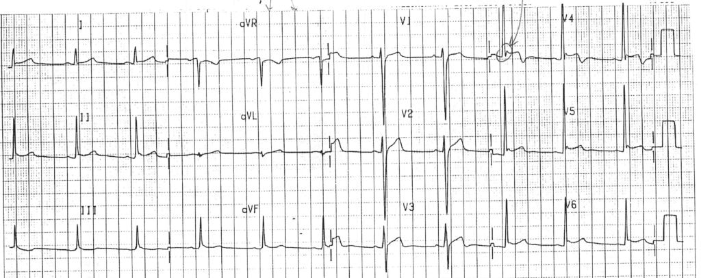 Early Repolarization mimicking myocardial infarction