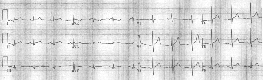 Acute pericarditis mimicking myocardial infarction