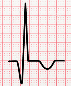 ECG image of an age undetermined myocardial infarction (heart attack) - Q wave with baseline ST segments and T wave inversion