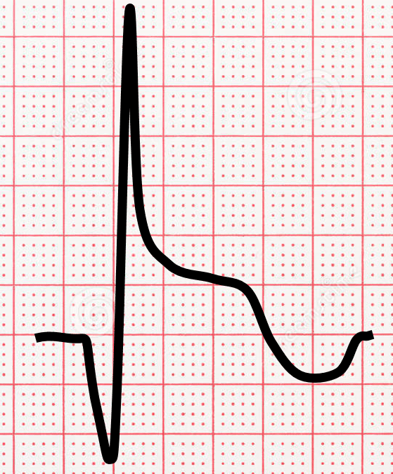 ECG image of a recent myocardial infarction (heart attack) - Q wave with some ST segment elevation and T wave inversion