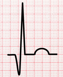 ECG image of an old myocardial infarction (heart attack) - Q wave with normal ST segments and normal T waves