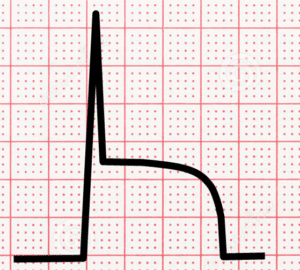 ECG image of acute injury - - ST segment elevation without a Q wave