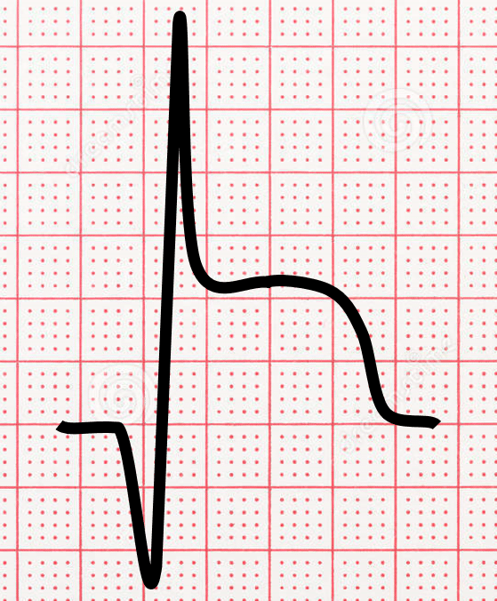 ECG image of an acute myocardial infarction (heart attack) - Q wave with ST segment elevation