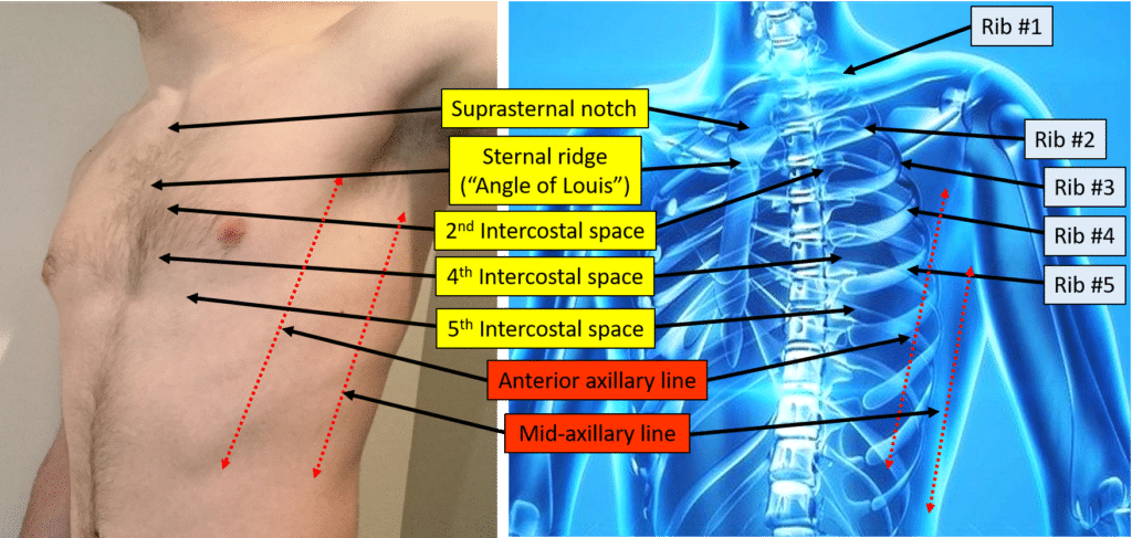 A picture of a man's chest and another picture of a rib cage as seen from a left, anterior oblique view. Labels and arrows show the ribs, the suprasternal notch, the sternal ridge, the second, fourth and fifth intercostal spaces, the anterior axillary line and the mid -axillary line.