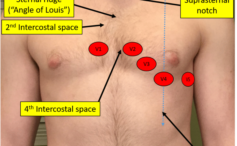 Proper Electrocardiogram (ECG/EKG) Lead Placement