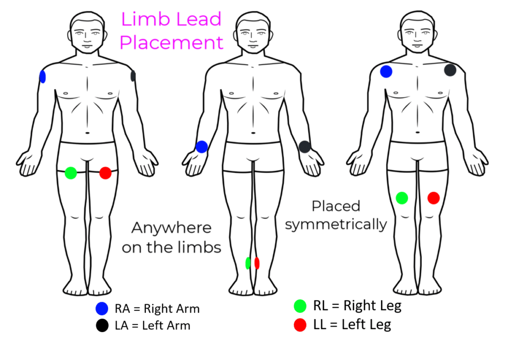 Image of three men with ECG electrodes on their arms and legs as looking at them from the front. Each picture shows the leads in different places on the limbs, but all are symmetrically placed