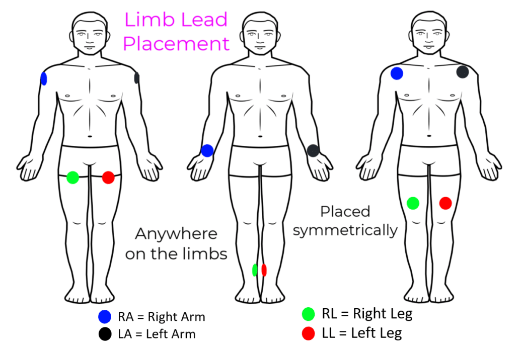 Proper Electrocardiogram (ECG/EKG) Lead Placement ECGEDU
