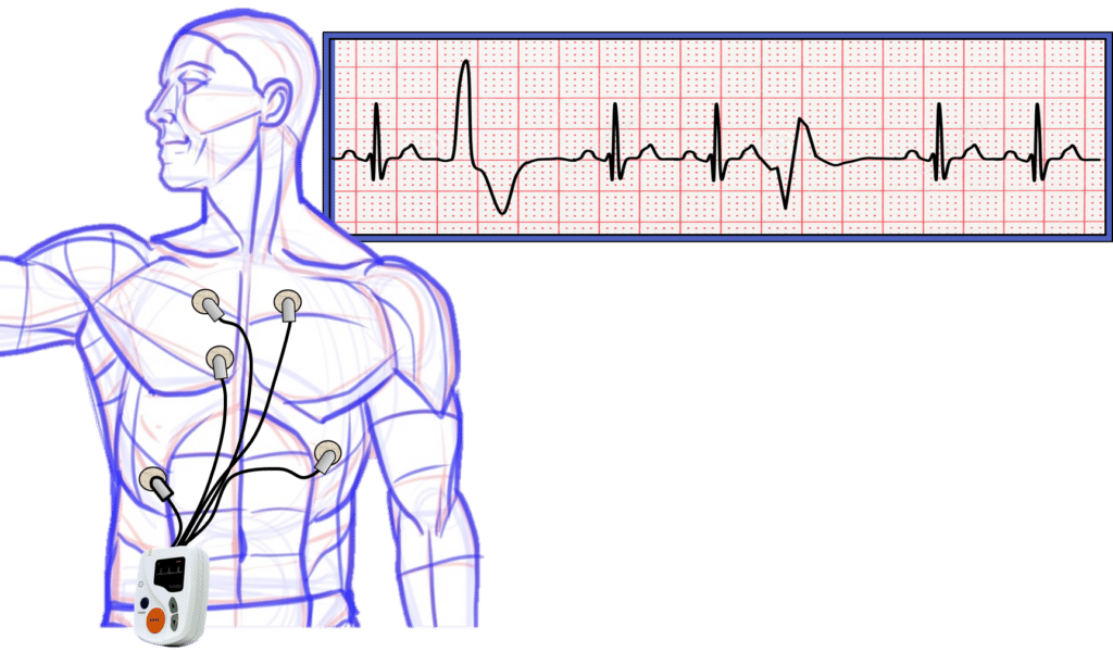 Illustration of a man with a Holter monitor attached to chest and a rhythm strip