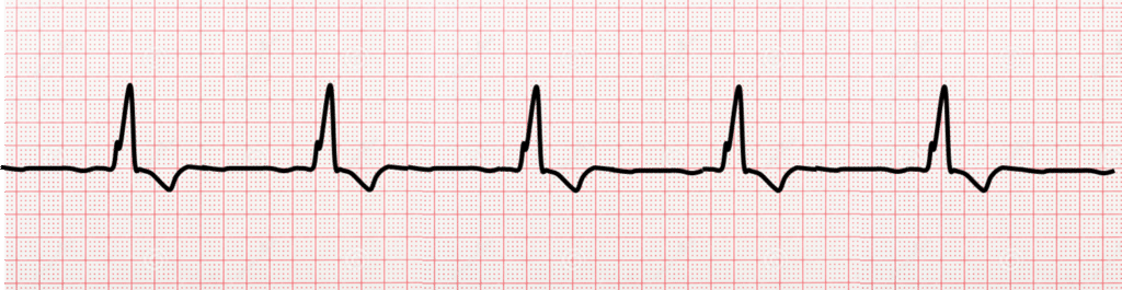 Rhythm strip of an idioventricular rhythm at 30 beats per minute