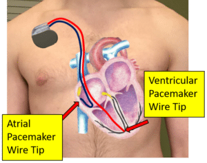 Picture of the heart with a dual chamber pacemaker system and the tips of the pacemaker leads resulting in pacemaker rhythms.