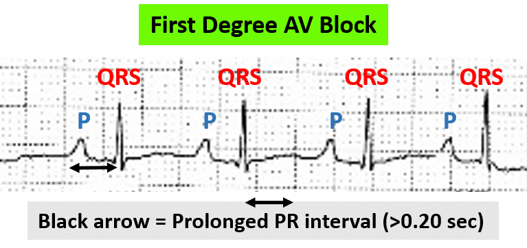 Rhythm strip with first-degree AV block