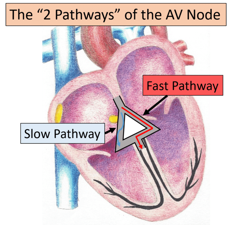 Differentiating Atrioventricular (AV) Blocks | ECGEDU.com