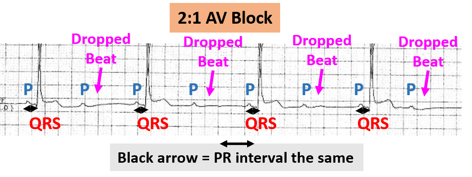 Rhythm strip showing 2:1 AV block