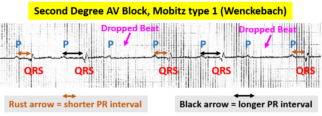 Rhythm strip showing second degree AV block, Mobitz type 1 (Wenckebach)