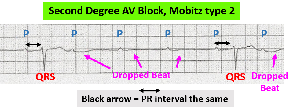 Rhythm strip showing second degree AV block, Mobitz type 2