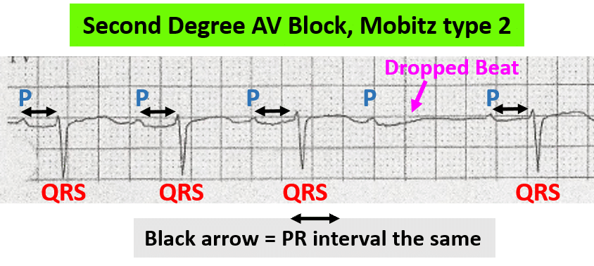 Rhythm strip showing second-degree AV block, Mobitz type 2