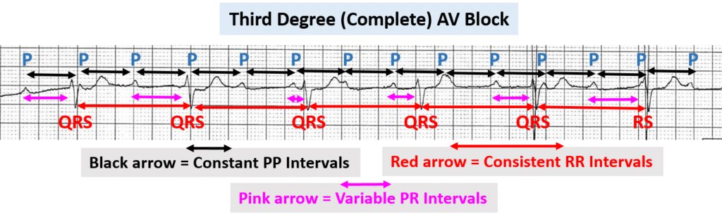 Rhythm strip showing third-degree (complete) AV block