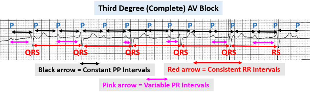 Differentiating Atrioventricular (AV) Blocks