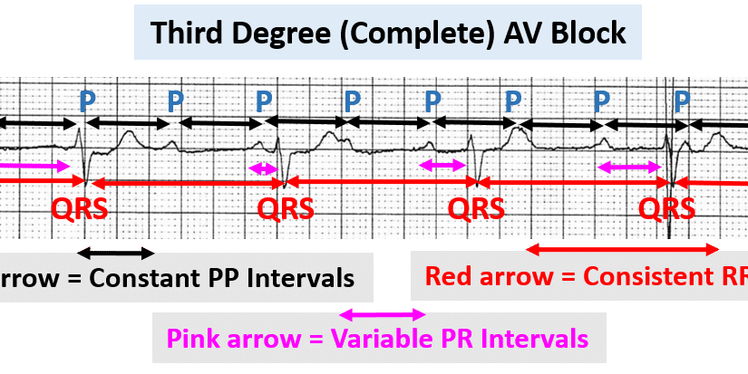 Differentiating Atrioventricular (AV) Blocks