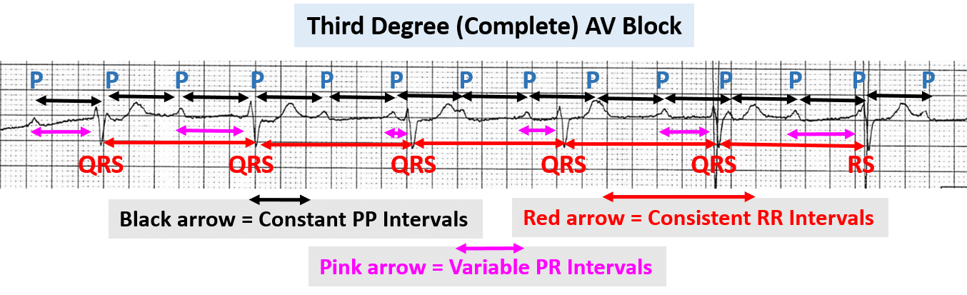 Differentiating Atrioventricular (AV) Blocks