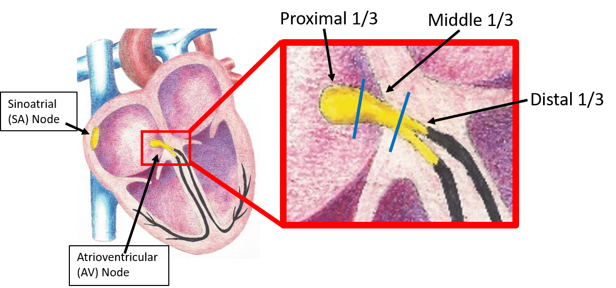 Picture of the heart and AV node (normal sized and enlarged)