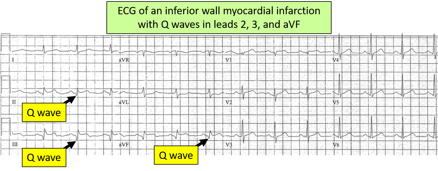 Defining Deducing Diagnosing With ECGs ECGEDU Defining Deducing Diagnosing With ECGs ECGEDU