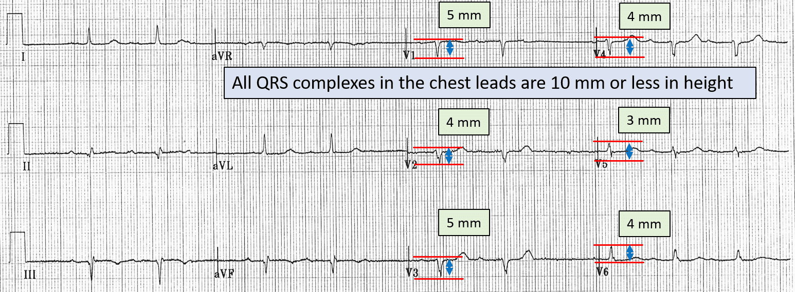 ECG showing low QRS voltage in the chest leads