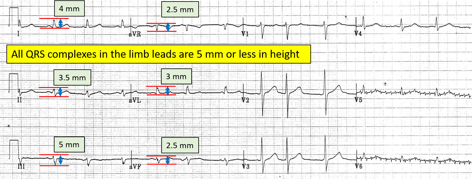 ECG showing low QRS voltage in the limb leads