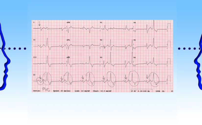 Understanding ECGs – Define, Deduce, and Diagnose (Part 1)