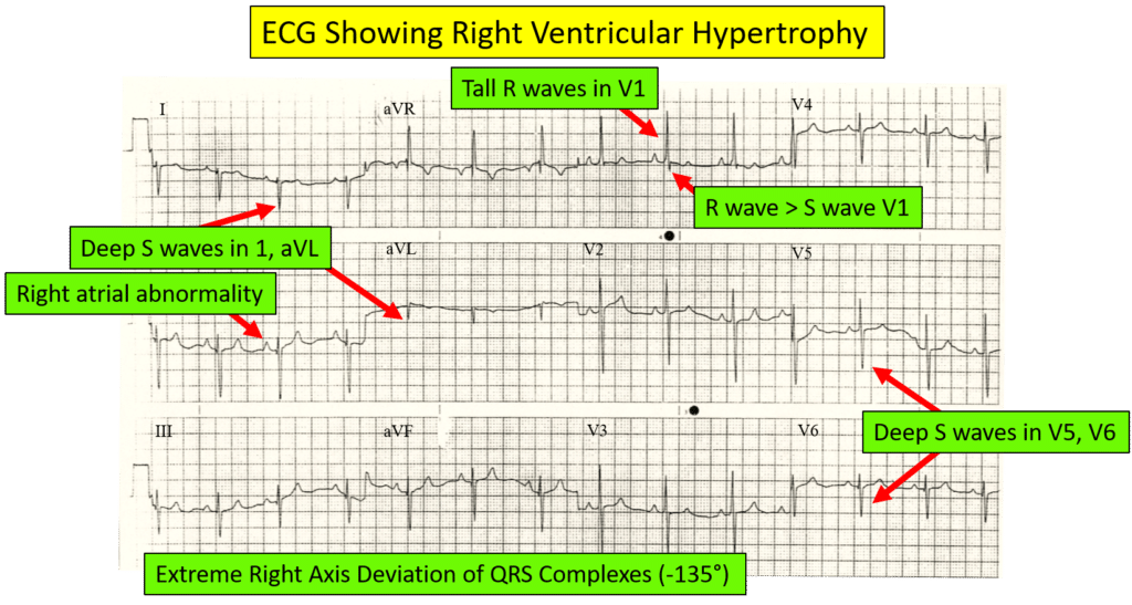 ECG of right ventricular hypertrophy pointing out the ECG characteristics