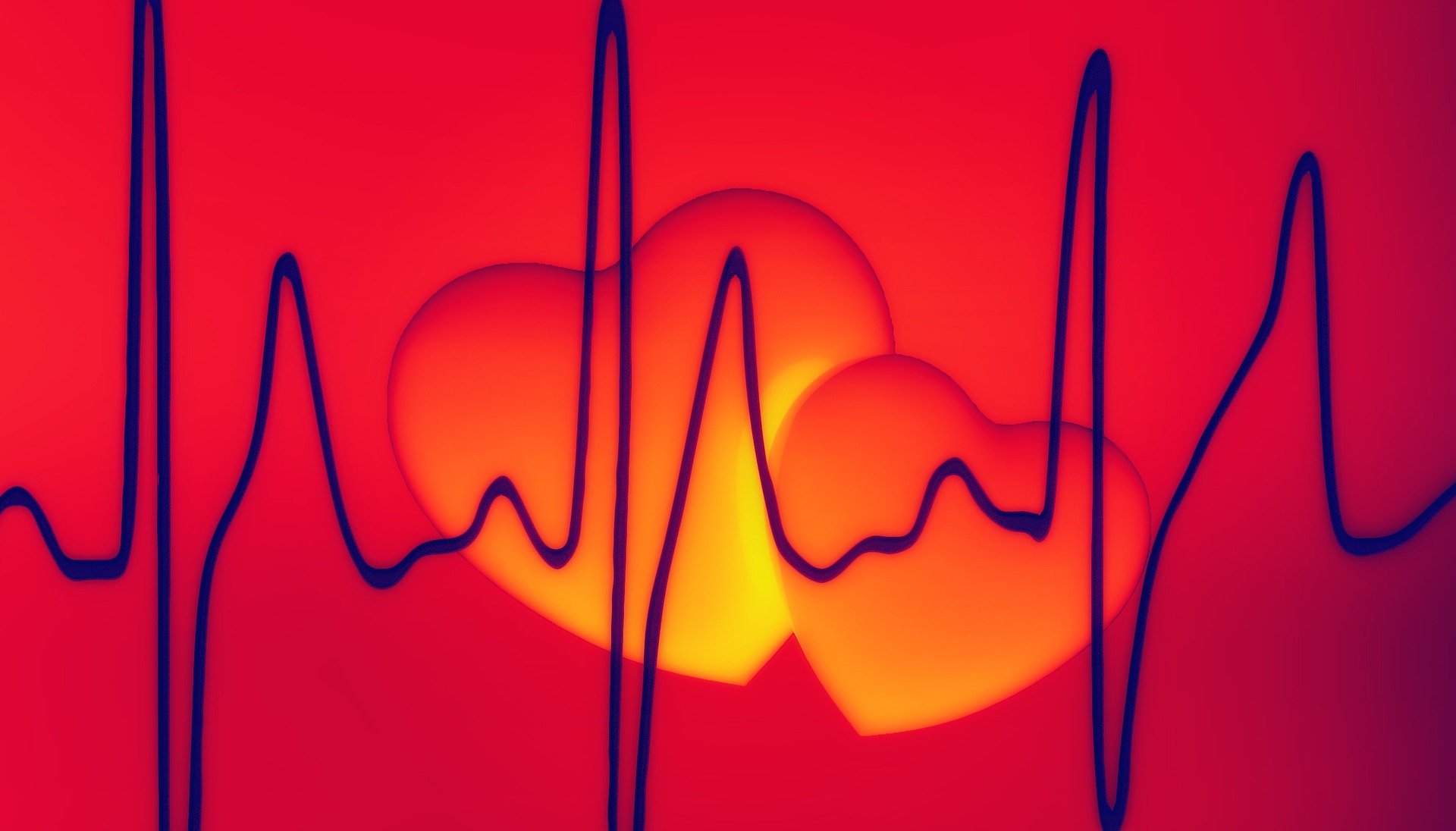 What are Arrhythmias? | ECGEDU.COM