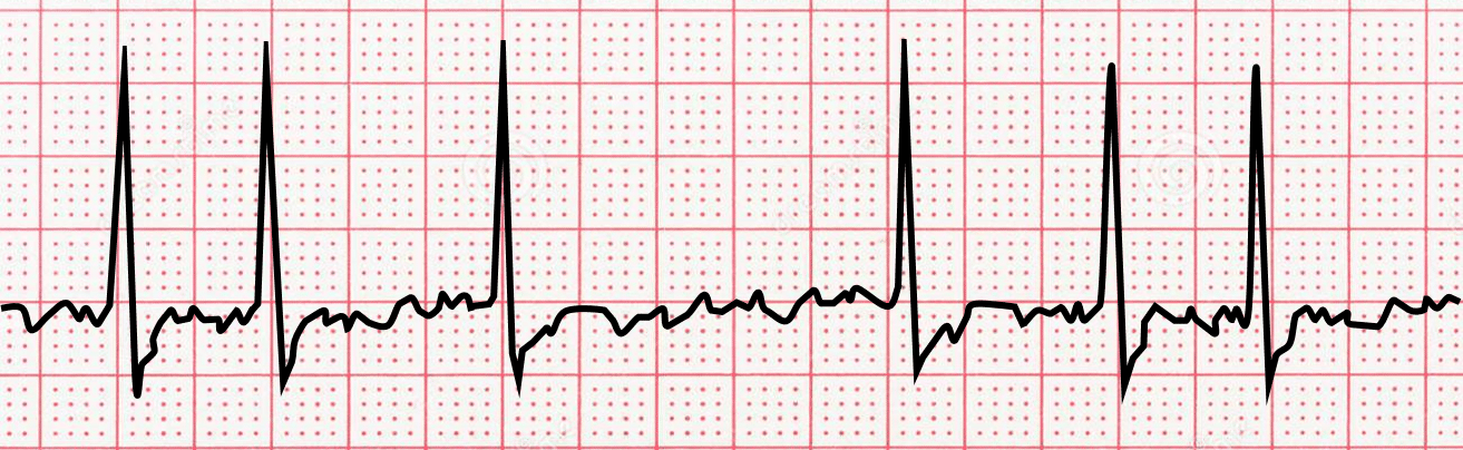 atrial fibrillation strip, black on red paper