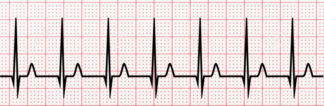 ECG Interpretation Examples – Typical Patterns You Should Know