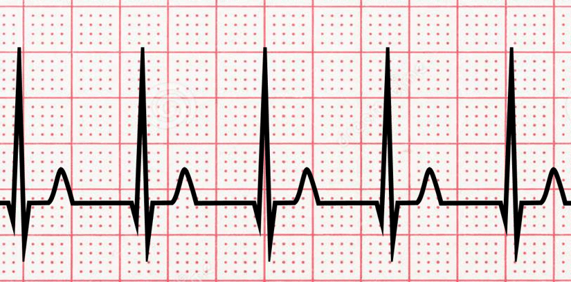 ECG Interpretation Examples – Typical Patterns You Should Know