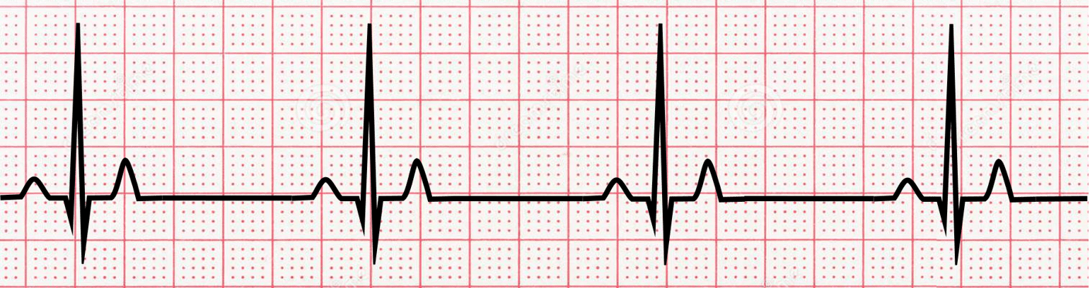 sinus bradycardia strip, black on red paper