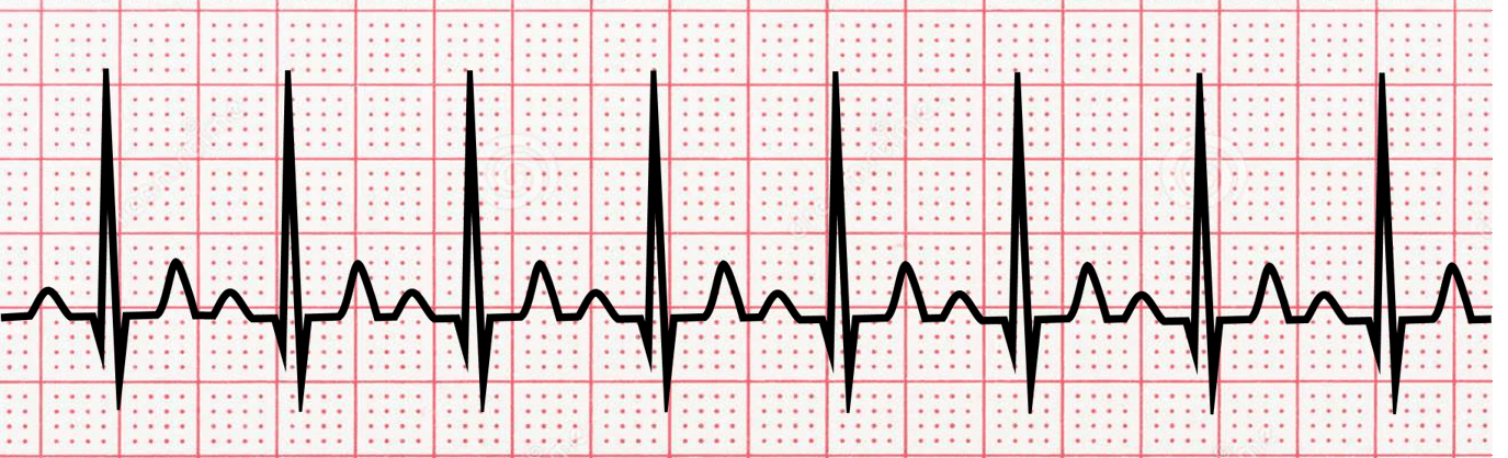 sinus tachycardia strip, black on red paper