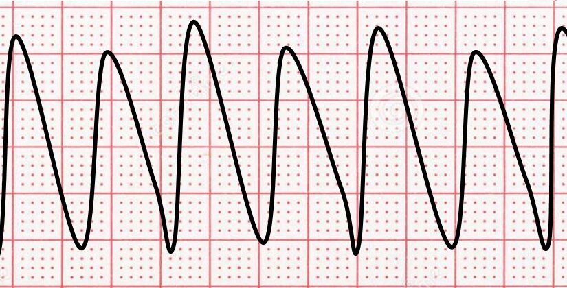 The Difference Between Ventricular Tachycardia and Ventricular Fibrillation