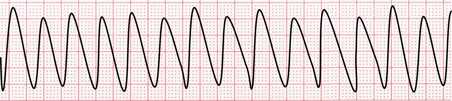 The Difference Between Ventricular Tachycardia and Ventricular Fibrillation