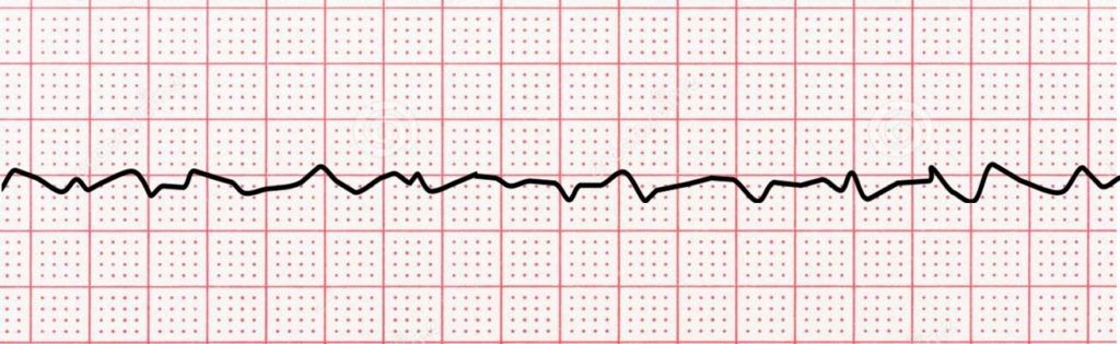 ventricular fibrillation strip, black on red paper