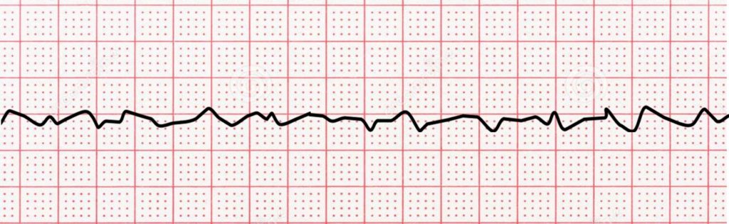 ventricular fibrillation strip, black on red paper