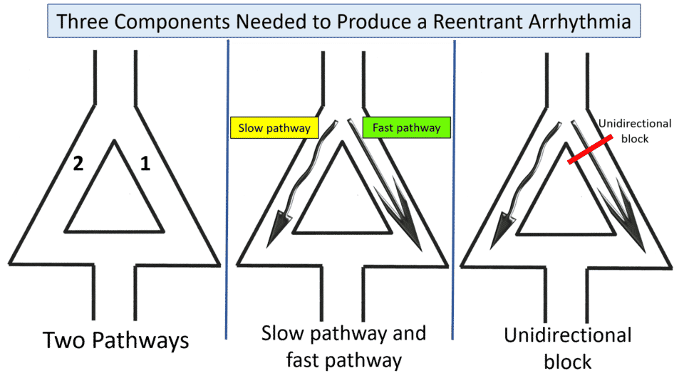R on T Premature Ventricular Complexes (PVC) Simplified