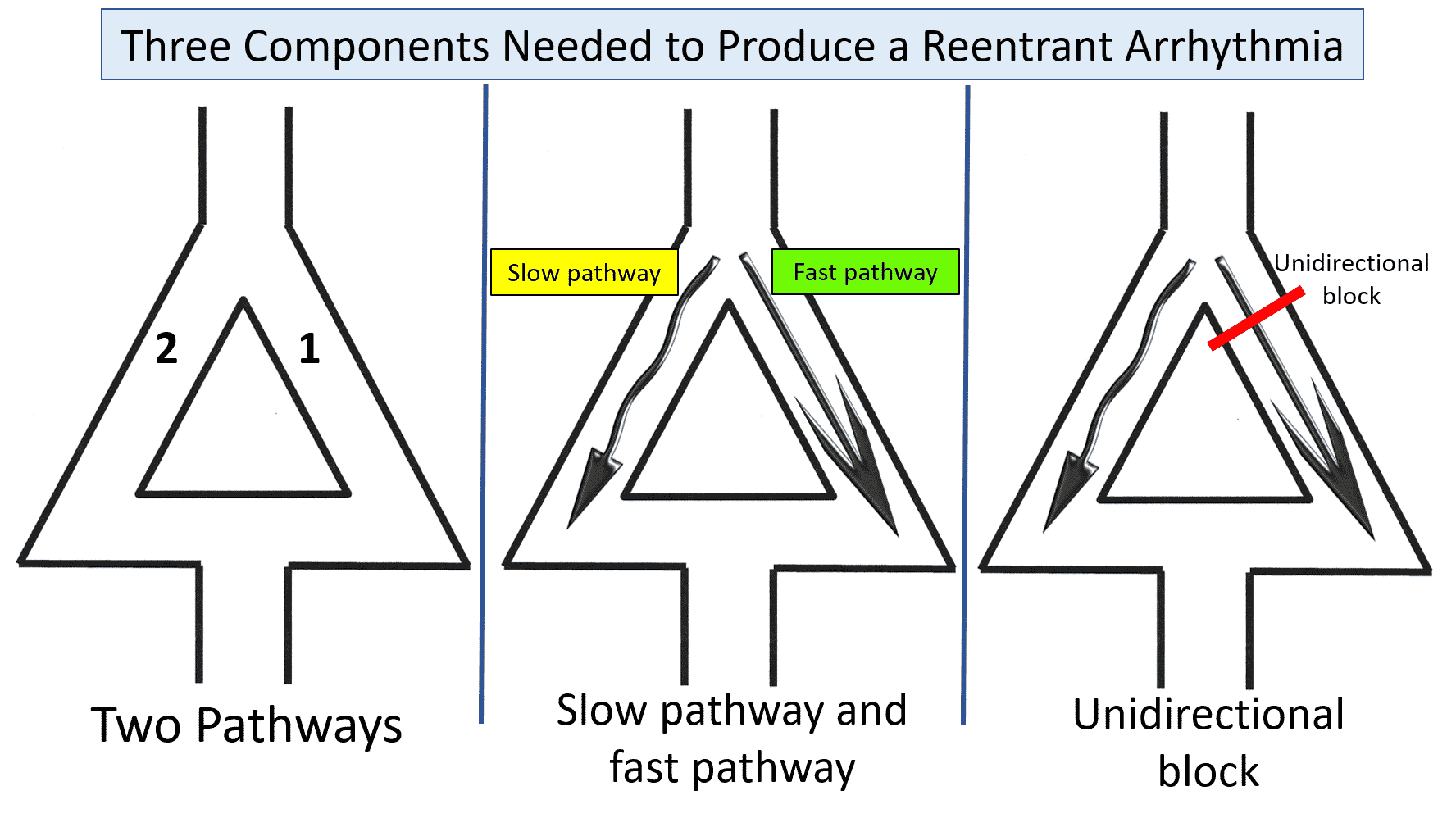 reentrant arrhythmia diagram 3 components