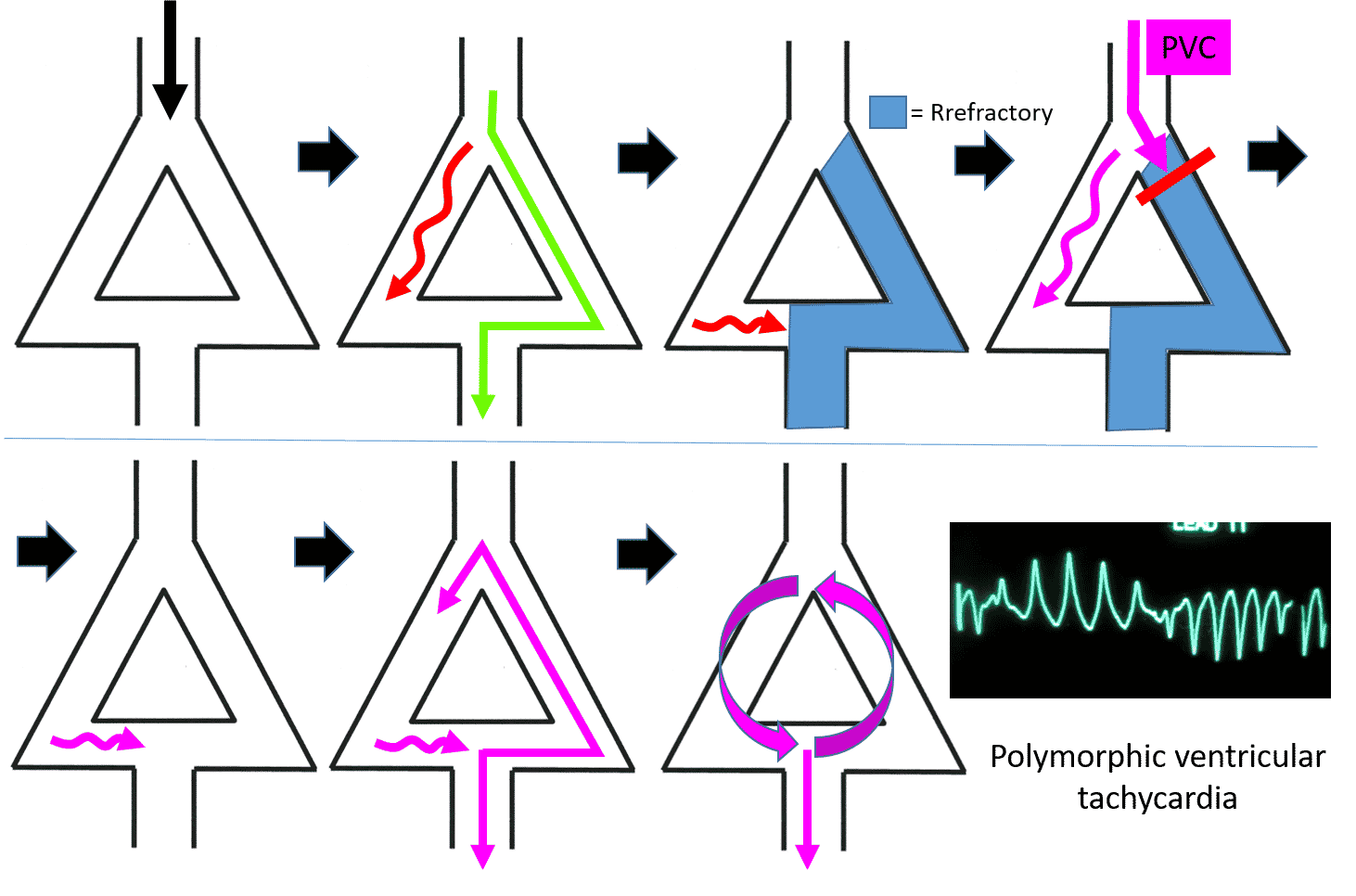 reentrant arrhythmia diagram vt