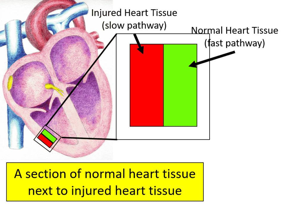 R on T Premature Ventricular Complexes (PVC) Simplified