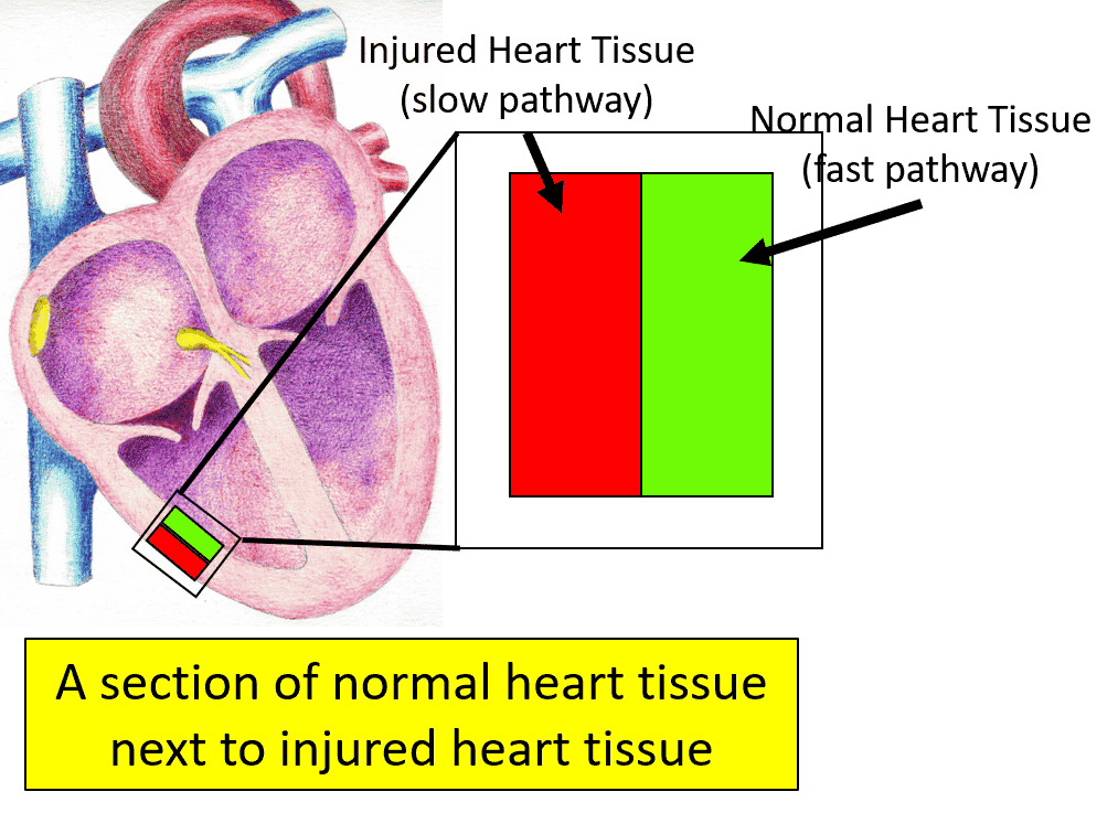 reentrant arrhythmia diagram normal tissue and injured tissue