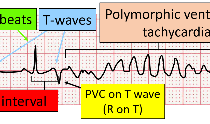 R on T Premature Ventricular Complexes (PVC) Simplified