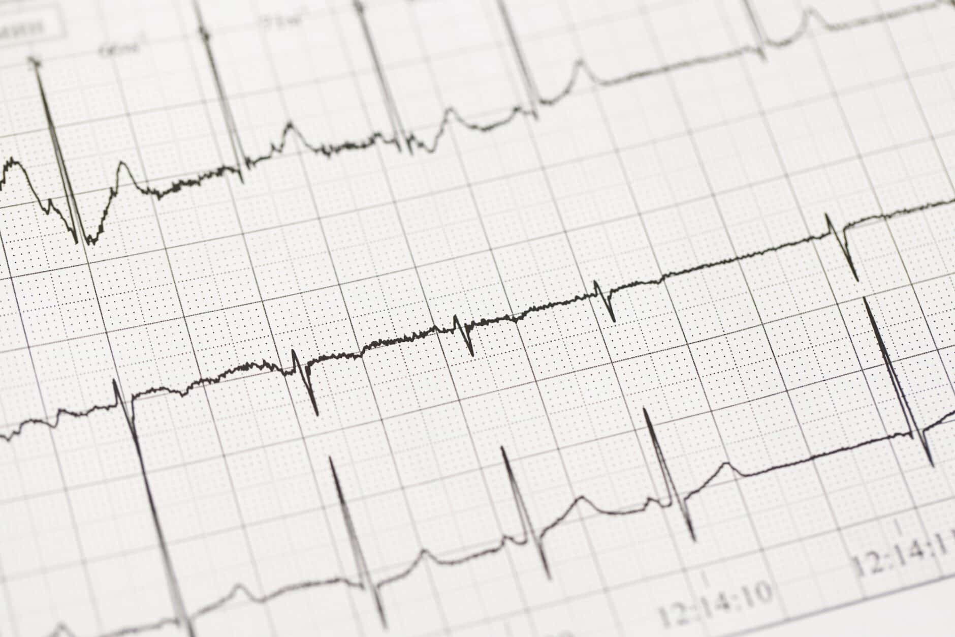 Using Practice EKG Strips To Improve Your EKG Interpretation Skills